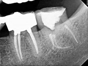 [ENDODONTISTS TRACK] Laser-Assisted Apical Micro-Surgery