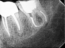 Load image into Gallery viewer, [ENDODONTISTS TRACK] Laser-Assisted Apical Micro-Surgery