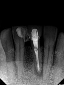 [ENDODONTISTS TRACK] Laser-Assisted Apical Micro-Surgery